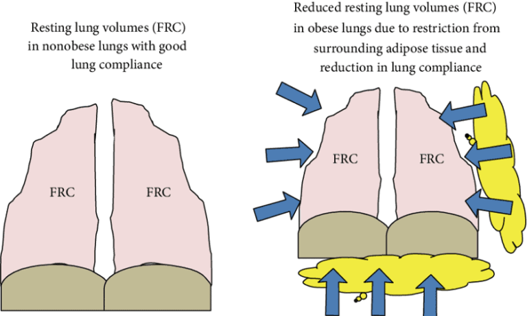 functional-residual-capacity-what-all-you-need-to-know