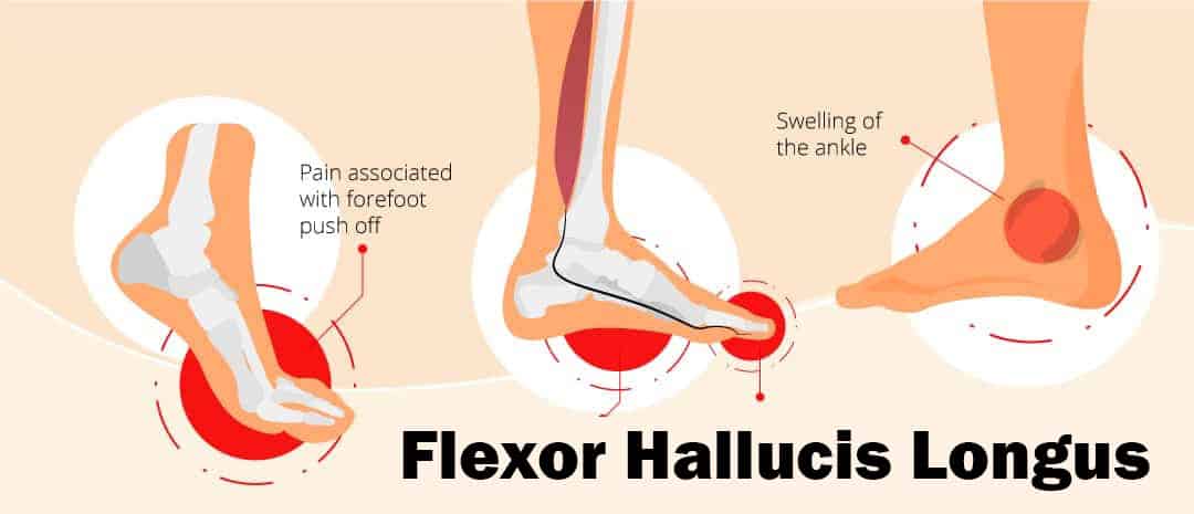 Flexor Hallucis Longus Muscle